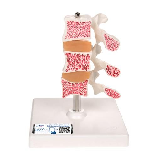 Deluxe cilvēka osteoporozes modelis (3 skriemeļi ar diskiem), noņemams, uz statīva