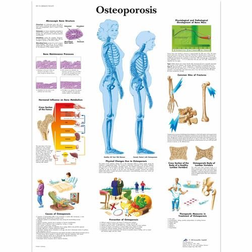 Osteoporozes plakāts