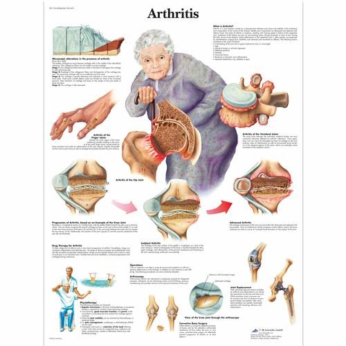 Artrīta plakāts