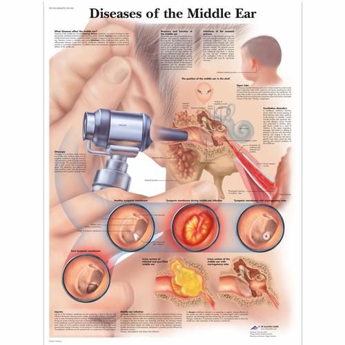 Middle Ear Diseases Chart